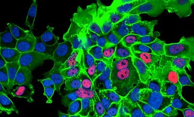 Inflammatory cells in tumour microenvironment promote the transformation of prostate cancer cells into treatment-resistant cells
